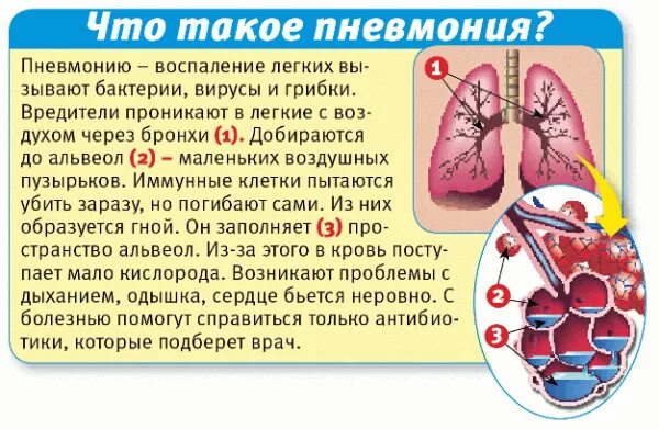 После лечения что бывает. Пневмония процесс заболевания. Воспалительный процесс в легких.