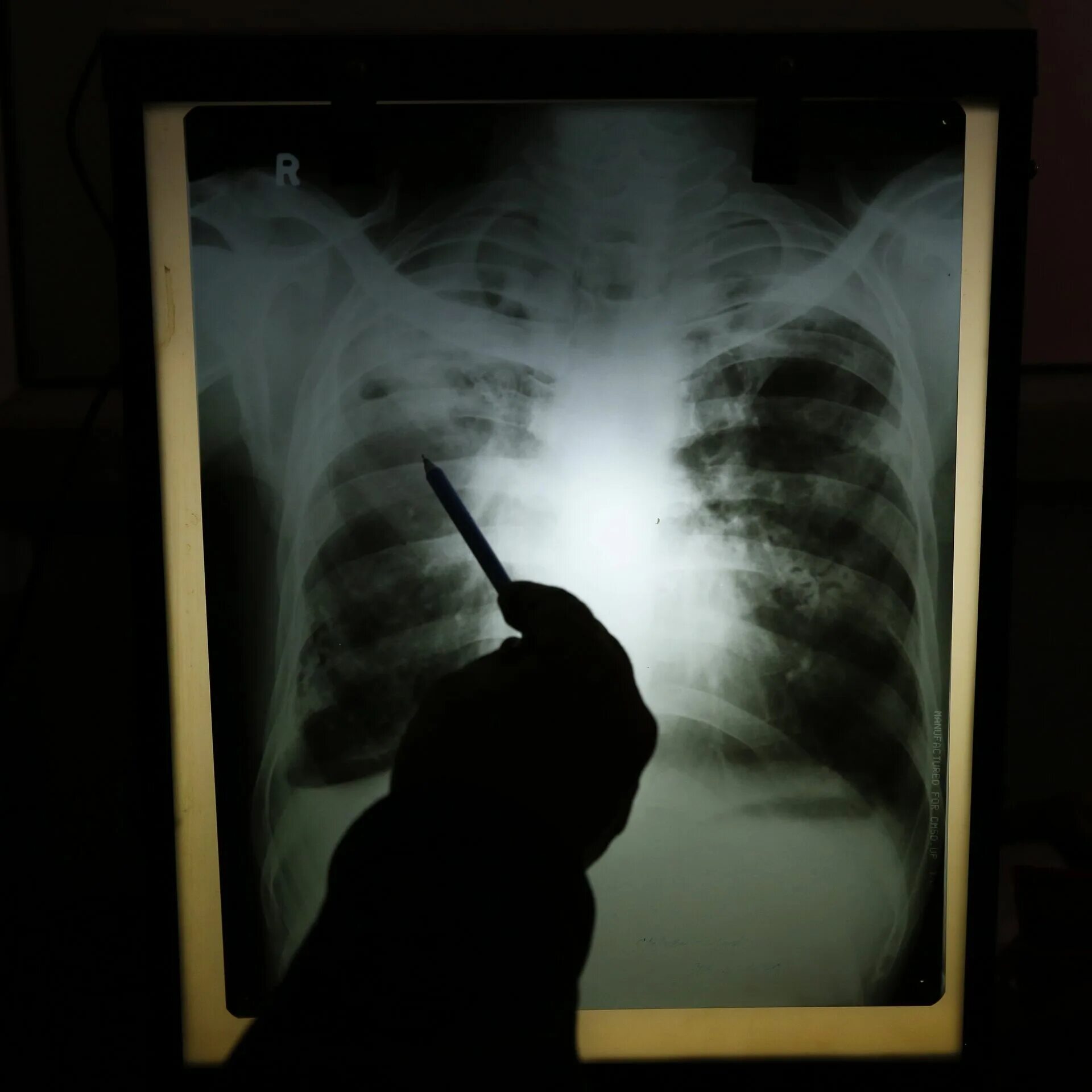 Штамм туберкулеза в великобритании. Рентген легких. Рентгеновские снимки в больнице куча. Рентгеновские снимки на стене в больнице.