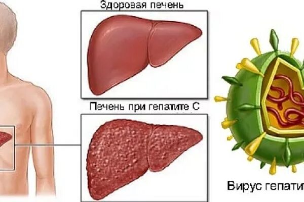 Вирусный гепатит печени. Вирус гепатита в.