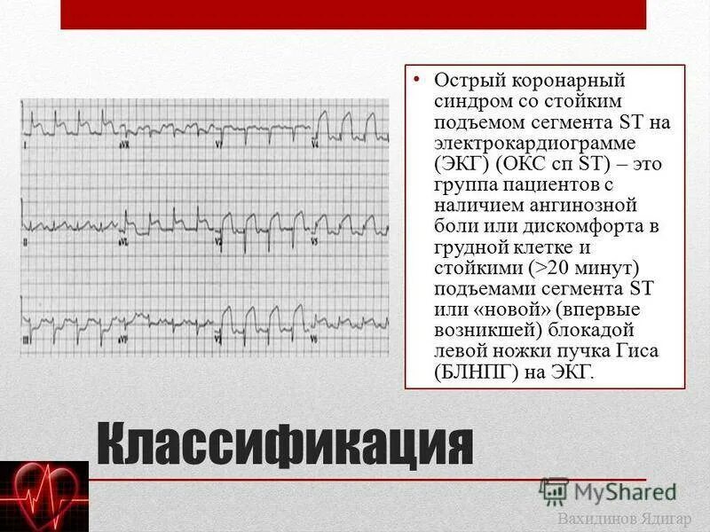 Экг подъем. Острый коронарный синдром без стойкого подъема сегмента St ЭКГ. ОИМ С подъемом St ЭКГ. Окс c подъемом сегмента St ЭКГ. Окс с подъёмом St клинические рекомендации ЭКГ.