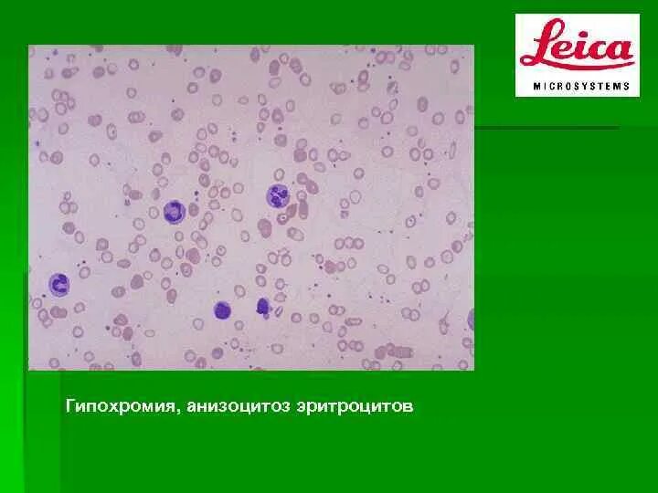 Гипохромия эритроцитов. Гипохромия анизоцитоз. анизоцитоз пойкилоцитоз гипохромия. гипохромия анизоцитоз микроцитоз. гипохромия эритроцитов у взрослого.