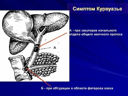 Закупорка желчных протоков