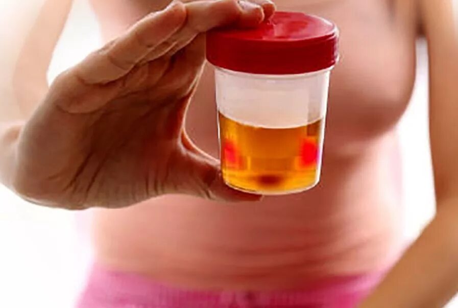 Симптомы цистицистита. Цистит уретрит у женщин. Частое мочеиспускание с кровью у женщин. Резкая боль при мочеиспускании. Рези и кровь при мочеиспускании у женщин.