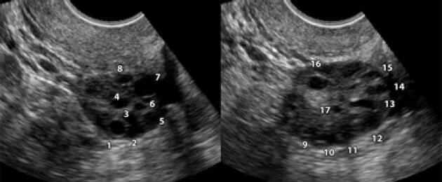 Функционирующий яичник. Синдром гиперстимуляции яичников УЗИ. СПКЯ УЗИ матки. Поликистоз яичников на УЗИ. Поликистозные яичники на УЗИ.