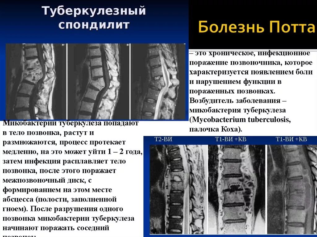 После операции на позвоночнике дают инвалидность. Спондилит поясничного отдела позвоночника мрт. Спондилит поясничного отдела позвоночника рентген. Туберкулезный спондилит позвоночника рентген.