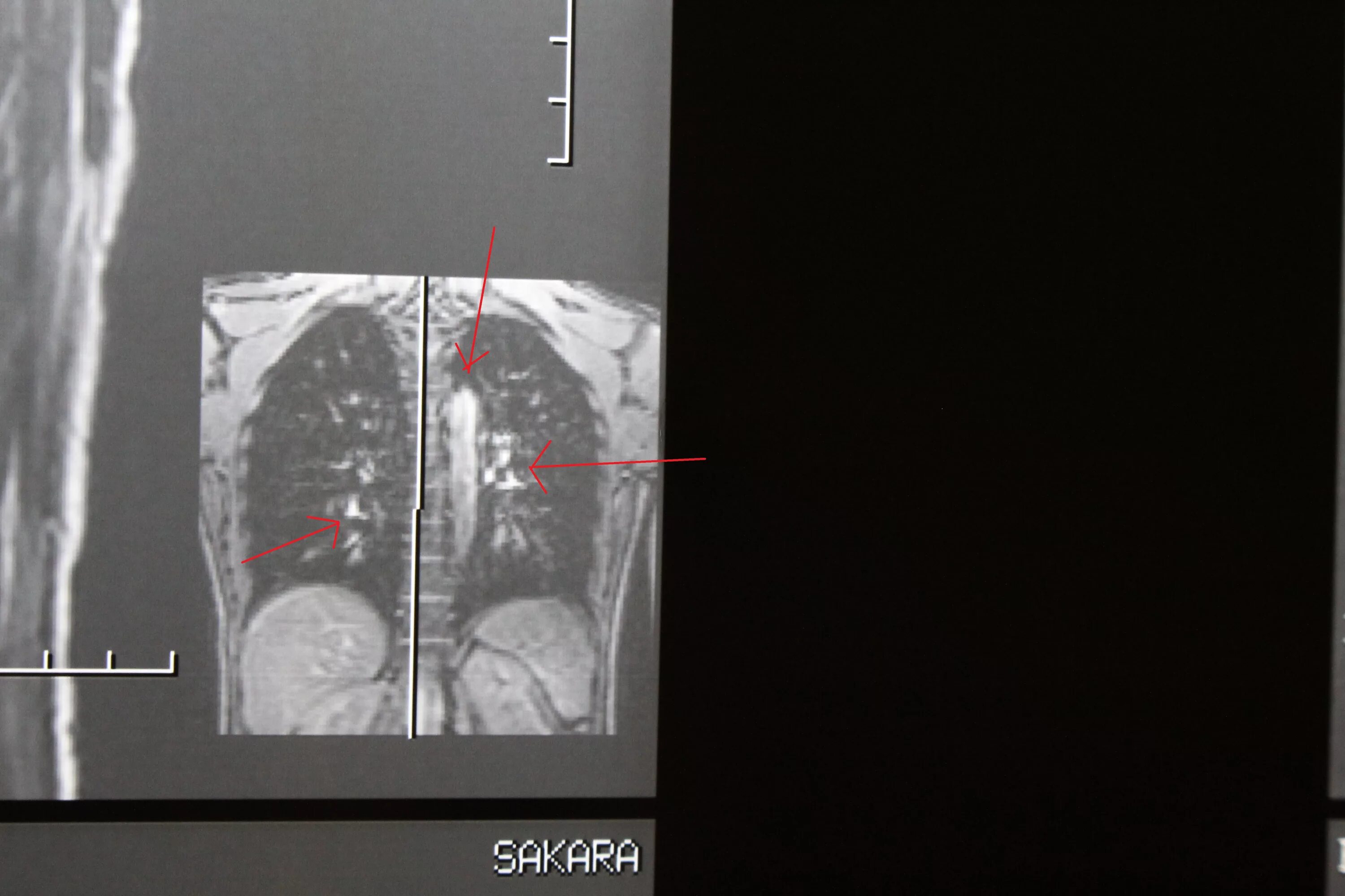 Белое пятно на снимке мрт головы. Снимки кт головы. Глиоз на мрт. Расширение периваскулярных пространств вирхова-робина мрт. Белые пятна на мрт.