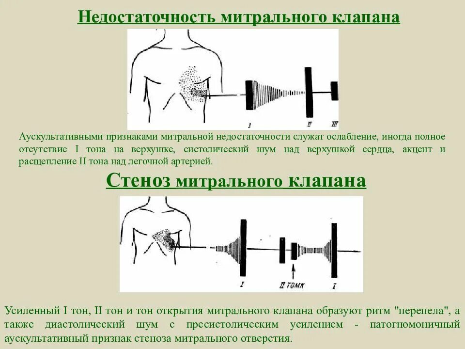 Митральная недостаточность систолический шум на верхушке. Шум над легочной артерией. Шум над легочной артерией. Синдром острого легочного сердца. Шум над легочной артерией.