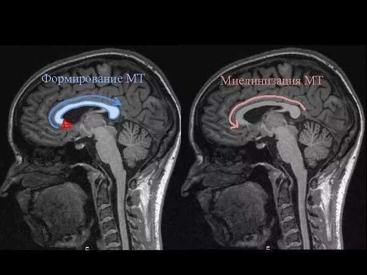 Расширенные ликворные пространства. Анатомия мозолистого тела головного мозга мрт. Ликвородинамика головного мозга мрт. Мозолистое тело на кт анатомия. Мрт головного мозга аксиальная проекция.