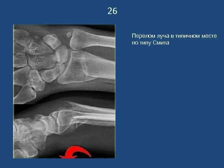 Перелом смита. Перелом смита лучевой кости. перелом смита лучевой кости рентген. переломы лучевой кости в типичном месте типа коллеса и смита. перелом луча в типичном месте смита.
