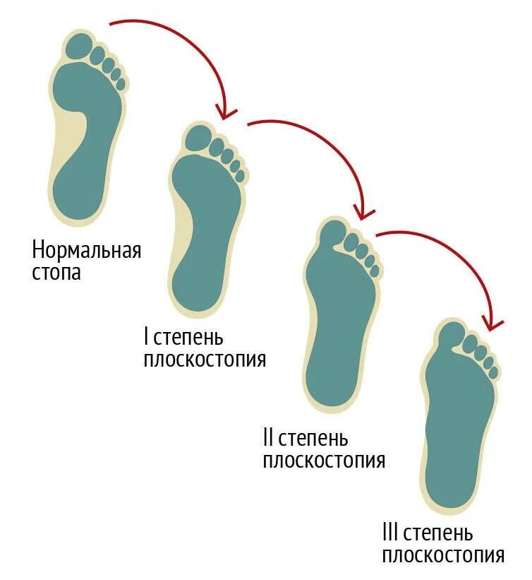 Нарушения стопы