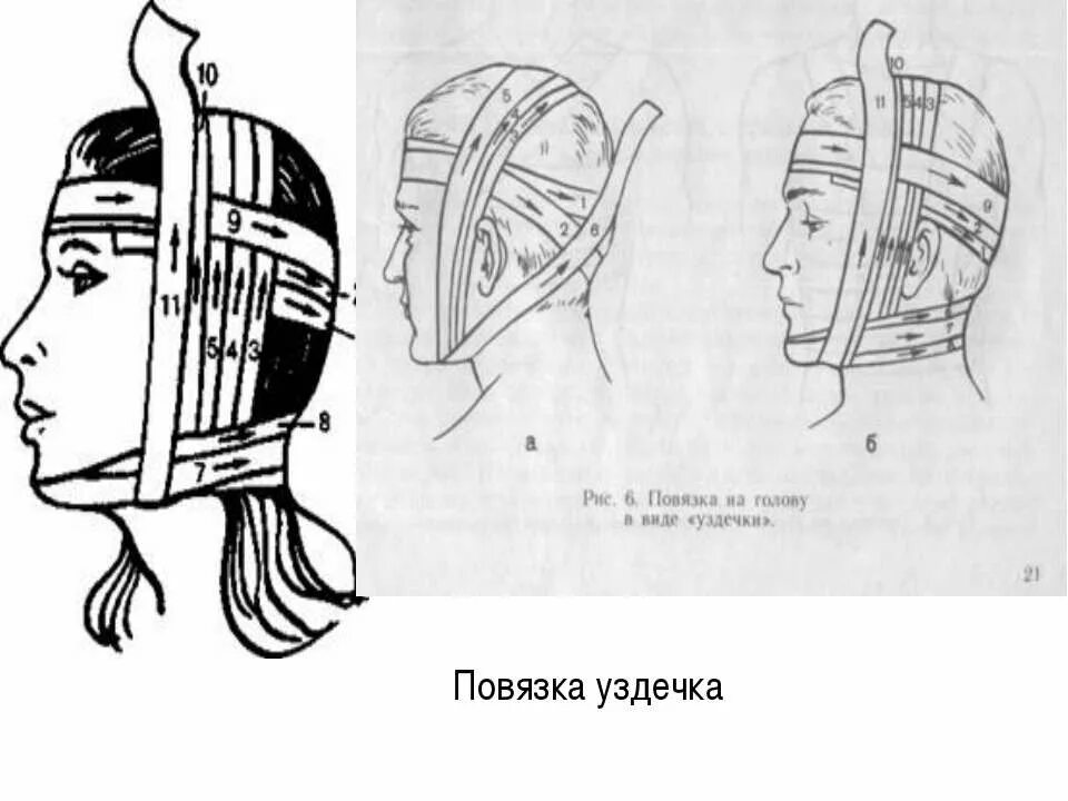 Технику наложения повязки «уздечка». Техника уздечка. Техника уздечка. Повязка уздечка техника наложения. Продемонстрируйте технику наложения повязки «уздечка».