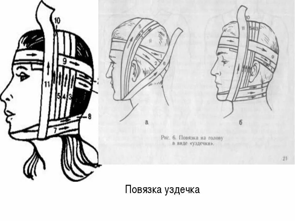 Десмургия повязка уздечка. Наложение повязки уздечка. Повязка уздечка техника наложения. Бинтовая повязка уздечка. Повязка уздечка накладывается