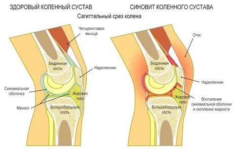 Синовит коленного сустава лечение отзывы