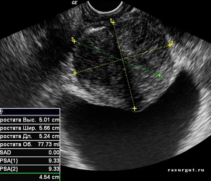 Пройти узи простаты. УЗИ предстательной железы простатит. Аденома предстательной железы на УЗИ. Гиперплазия предстательной железы УЗИ. УЗИ предстательной железы трансабдоминально.