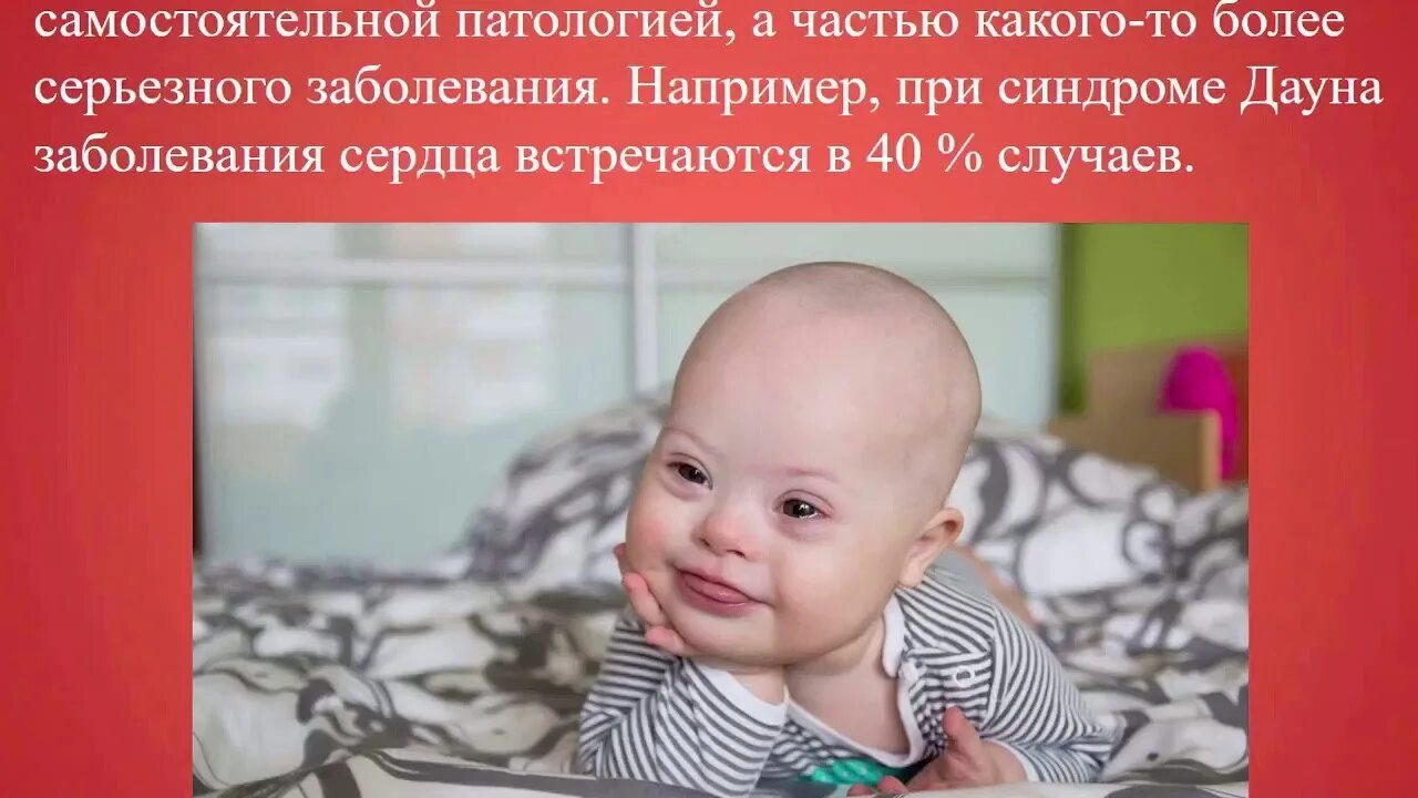 Синдром дауна пороки сердца. Врожденный венозный порог. пороки развития сердца у детей с синдромом дауна.