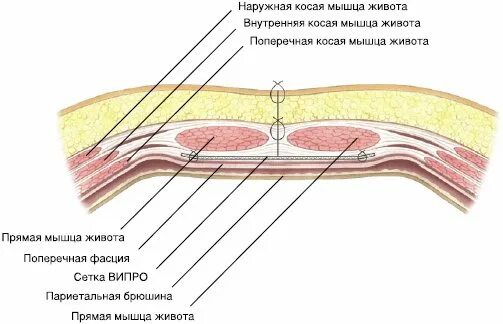 Сколько приживается грыжа сетка. Sublay пластика пупочной грыжи. сетчатый эндопротез sublay. вентральная грыжа сетка.