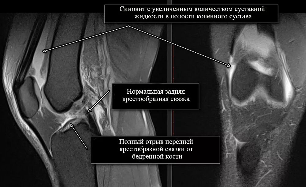 Что показывает мрт коленного сустава у взрослых. Виллонодулярный синовит мрт. разрыв пкс коленного сустава на мрт. повреждение пкс коленного сустава мрт.
