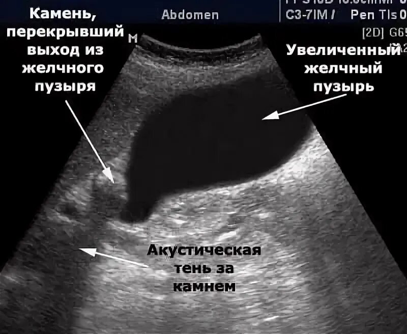 Расширенный желчный пузырь. УЗИ картина отключенного желчного пузыря. УЗИ снимки отключенного желчного пузыря. УЗИ признаки отключенного желчного пузыря. Сморщенный желчный пузырь на УЗИ.