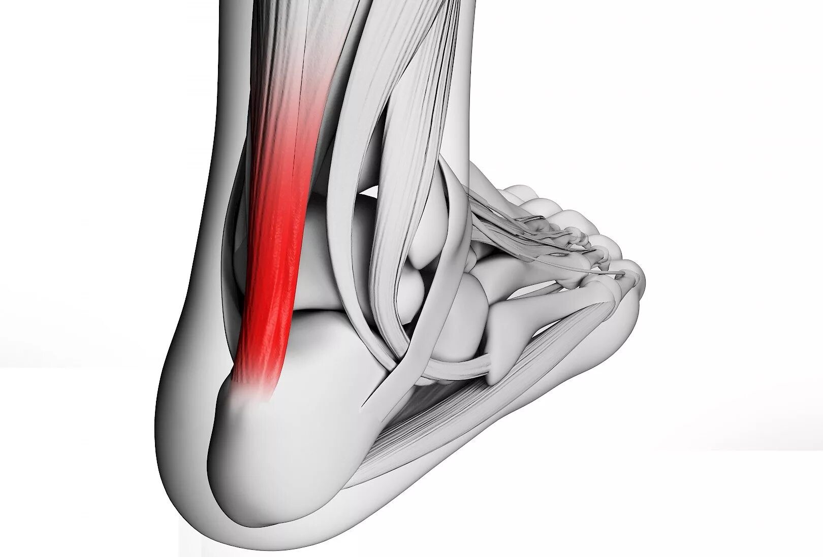 Ахилесова сухожилия. Тендинита ахиллова сухожилия. Тендиноз ахиллесова сухожилия. Воспаление ахиллесова сухожилия.