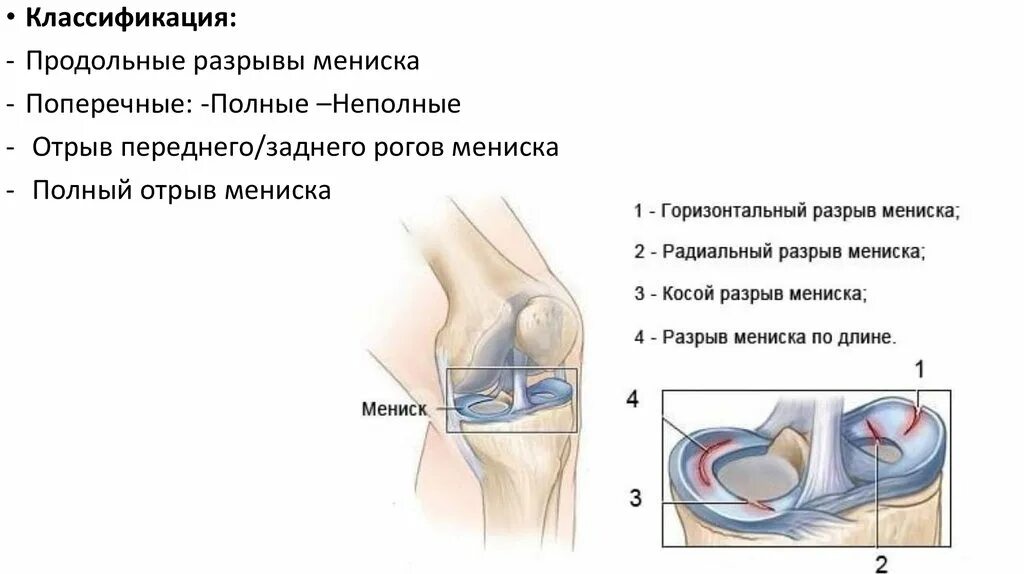 Болит ли мениск