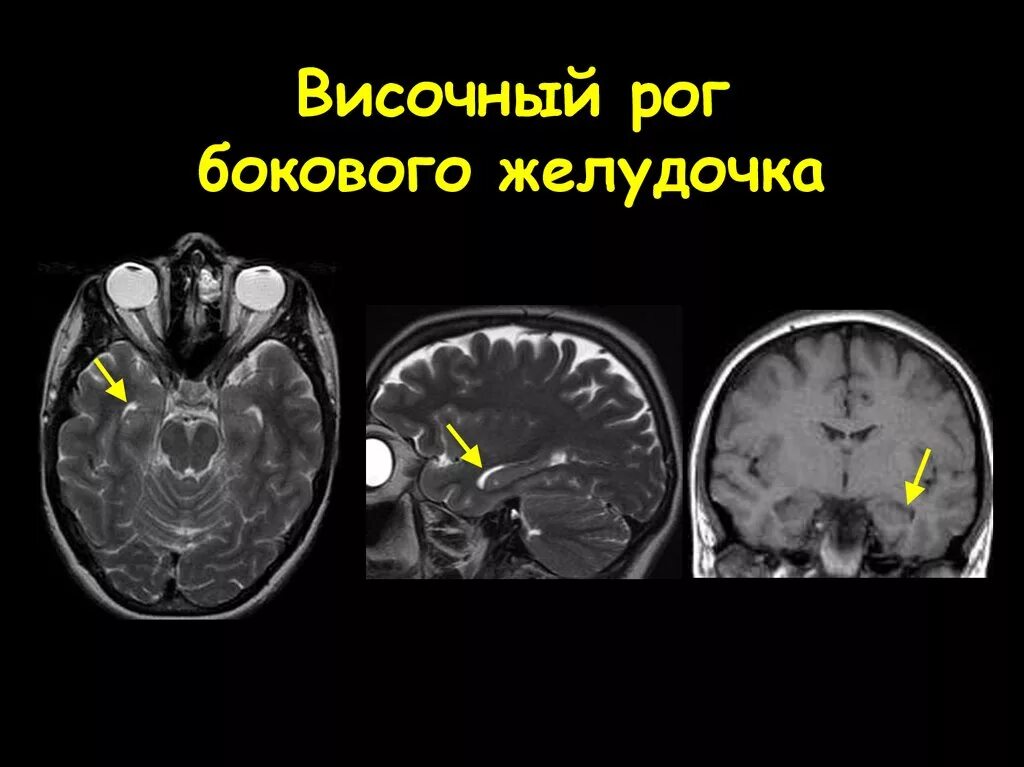 Киста желудочка головного мозга. Височный Рог бокового желудочка на мрт. Нижние рога боковых желудочков кт. Расширение височного рога бокового желудочка на кт. Кистозное расширение височного рога левого бокового желудочка.