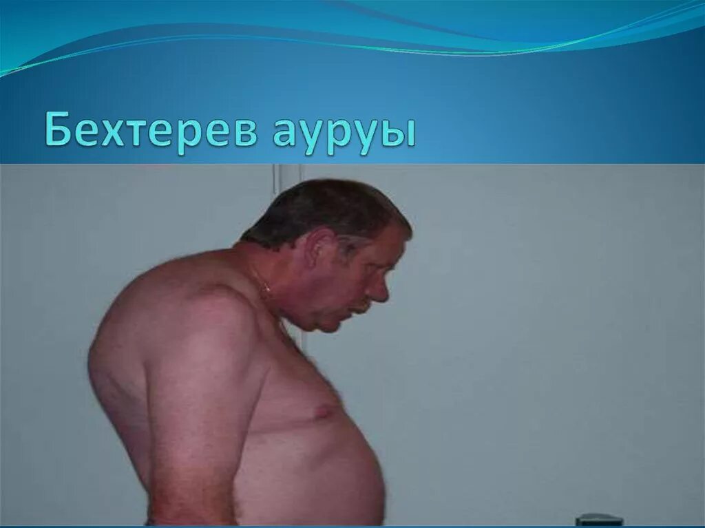 Болезнь бехтерева как выглядит. Бехтерев. профилактика болезни бехтерева.