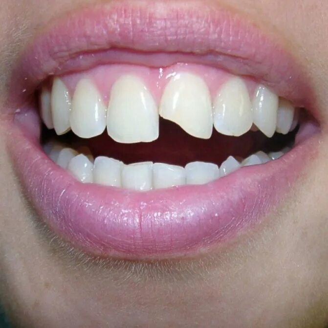 наращивание зубов до и после. молочные зубы у детей. наращивание переднего зуба ребенку. наращивают ли зубы детям. наращивают ли зубы детям.