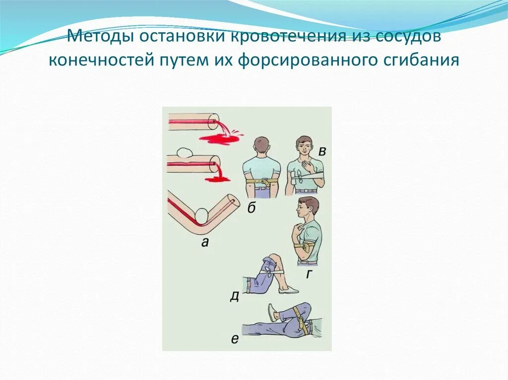 Способы остановки кровотечения. Методы остановки кровотечения путем форсированного сгибания. Методы остановки кровотечения из сосудов конечностей путем их. Остановка кровотечения из сосуда. Останавливать кровотечение путем