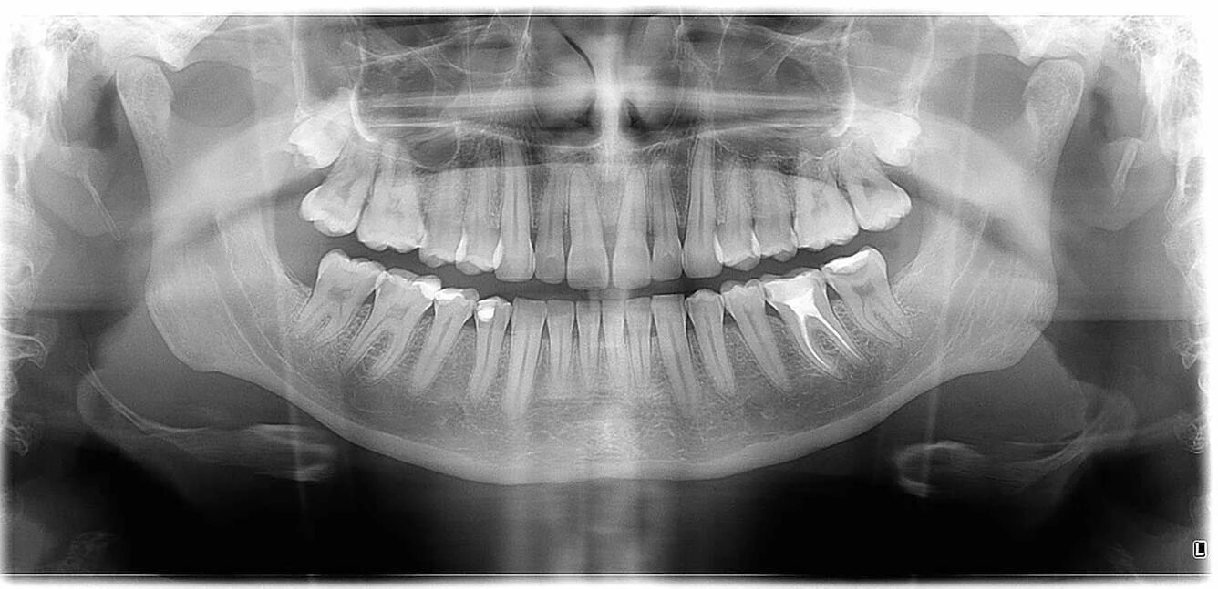 Панорамный снимок зубов. Панорамная рентгенограмма. Рентген зубов панорамный. Панорамная рентгенография нижних.