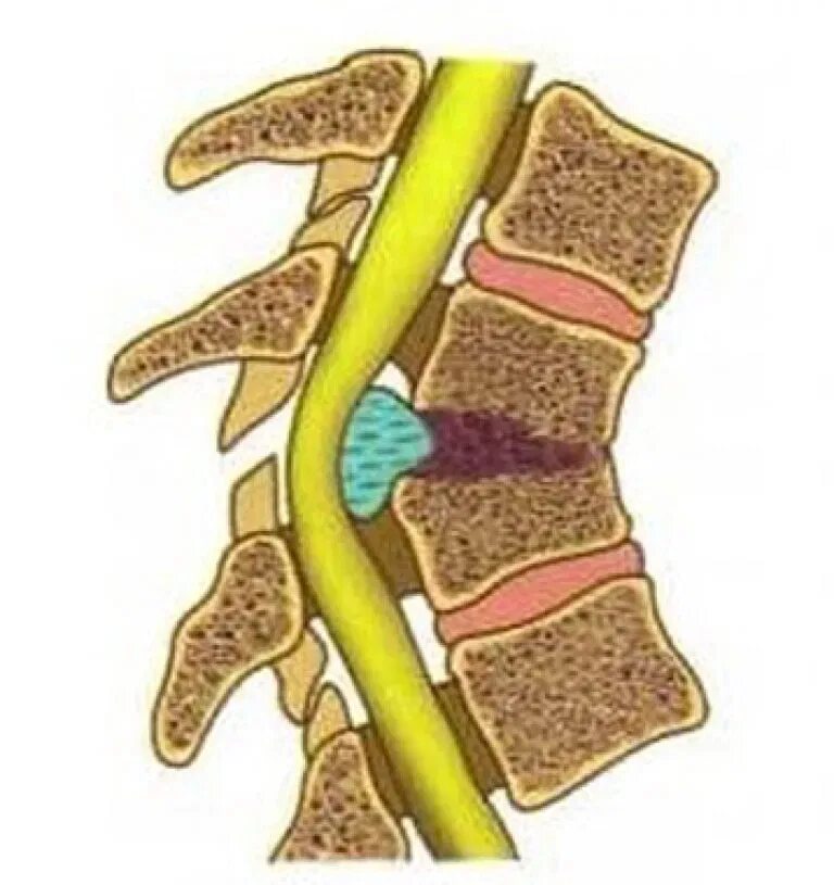 Сдавление спинного. Дискогенная миелопатия. Вертеброгенная шейная миелопатия. Сдавление Корешков спинного мозга. Миелопатия шейного отдела позвоночника.