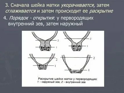 Короткая матка при беременности. Этапы раскрытия шейки матки перед родами. Открытие шейки. Шейка матки 5мм норма. Слизистая пробка перед родами.