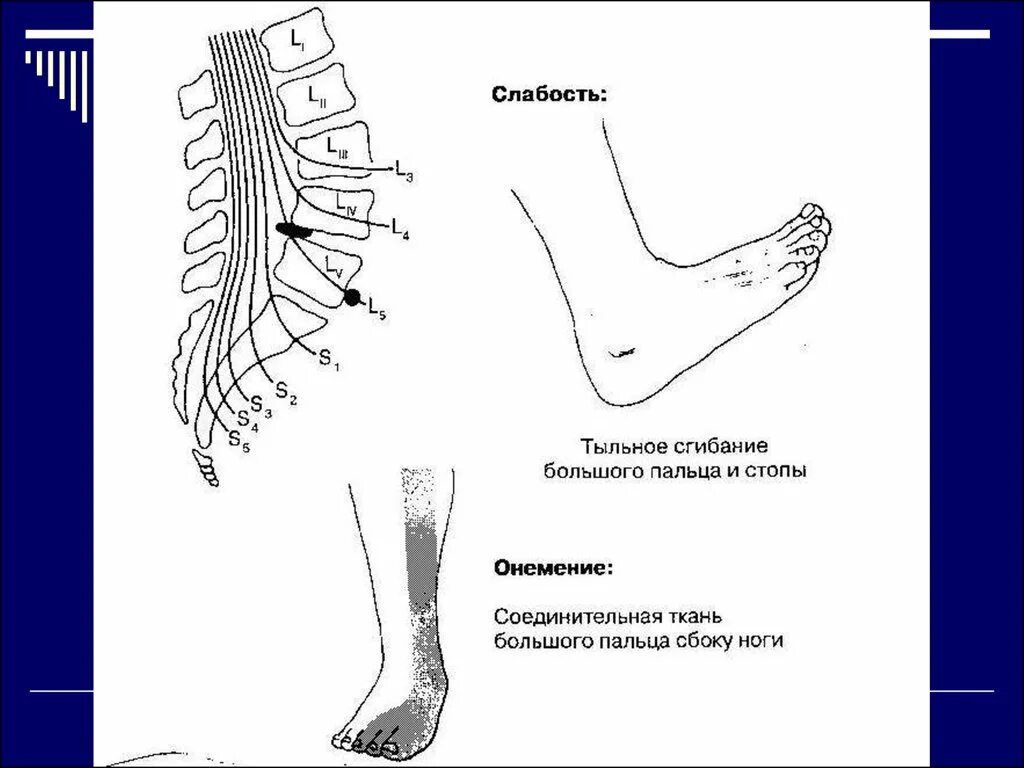 Радикулопатия l5 s1. Флексия стопы. Тыльная флексия стопы. Плантарная флексия стопы это. Плантарное сгибание стопы.