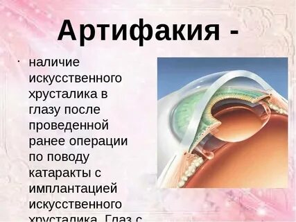 Артифакия мкб 10 у взрослых