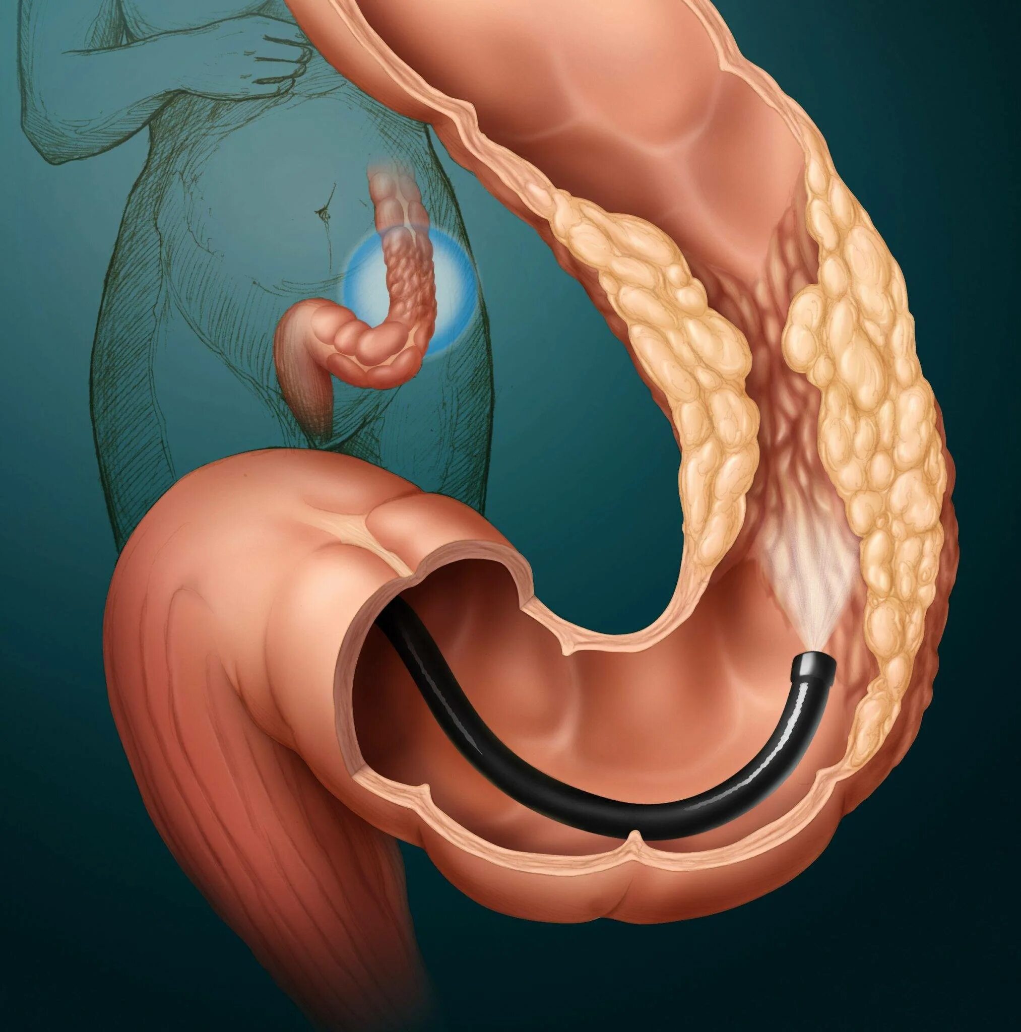 Полипы толстой кишки колоноскопия. Колоноскопия ободочной кишки. Полипы прямой кишки колоноскопия. Кишечник изнутри колоноскопия.