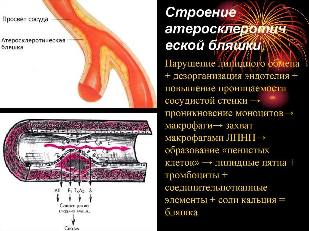 Чем характеризуются сосуды. Строение эндотелия сосудов. Артерия с атеросклеротической бляшкой. Кальцинированная атеросклеротическая бляшка. Эндотелиоциты сосудов строение.