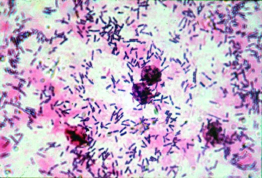 Haemophilus в мазке у мужчин. Палочки Дедерлейна микроскопия. Бактериальный вагиноз микроскопия мазка.