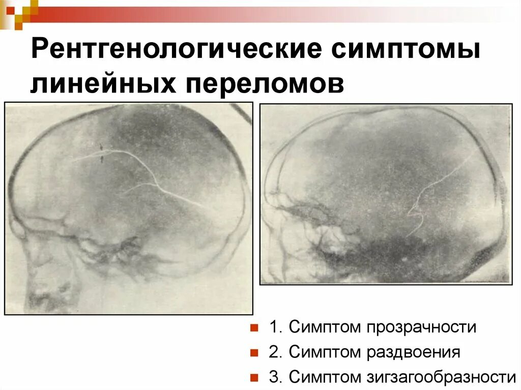 Перелом кости свода черепа. Перелом теменной кости черепа рентген. Линейный перелом свода черепа. Линейный перелом костей свода черепа.