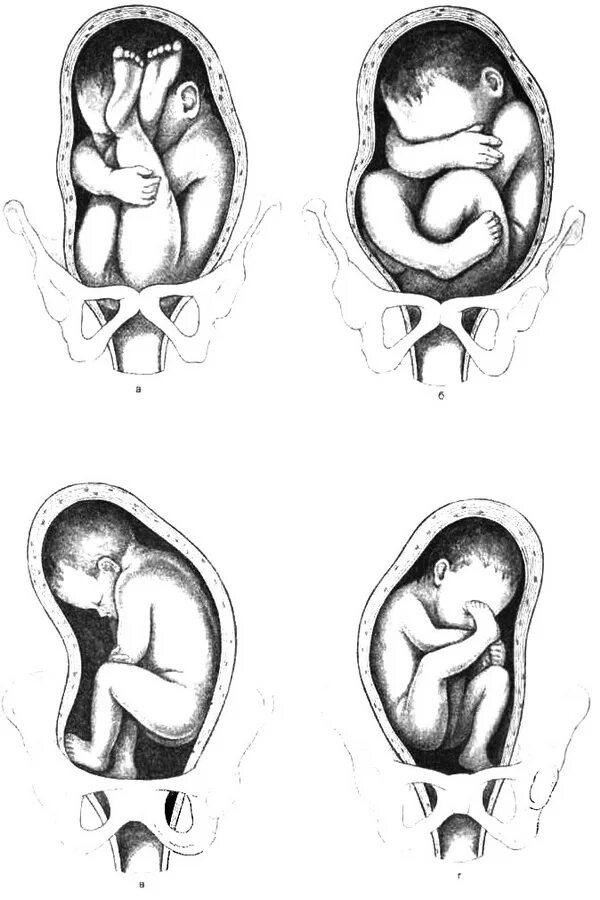 Положение плода в животе. Тазовое ножное предлежание плода. Неполное ножное предлежание плода. Смешанное ягодичное предлежание плода роды. Смешанное ножное предлежание плода.