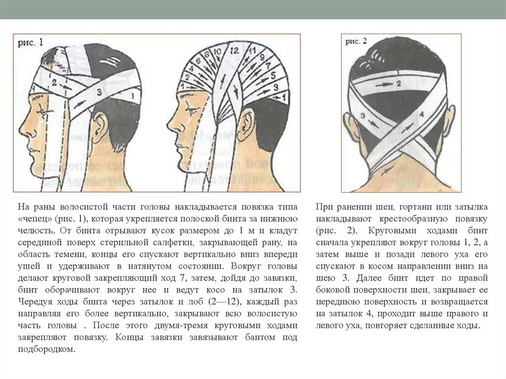 Повреждение затылка какая повязка. Повязка чепец при ранении головы. Повязка на чепец бинтом. Повязка чепец при переломе нижней челюсти алгоритм. Десмургия повязка чепец.