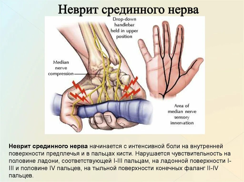 Повреждение срединного нерва. При поражении срединного нерва. Повреждение срединного нерва симптомы.