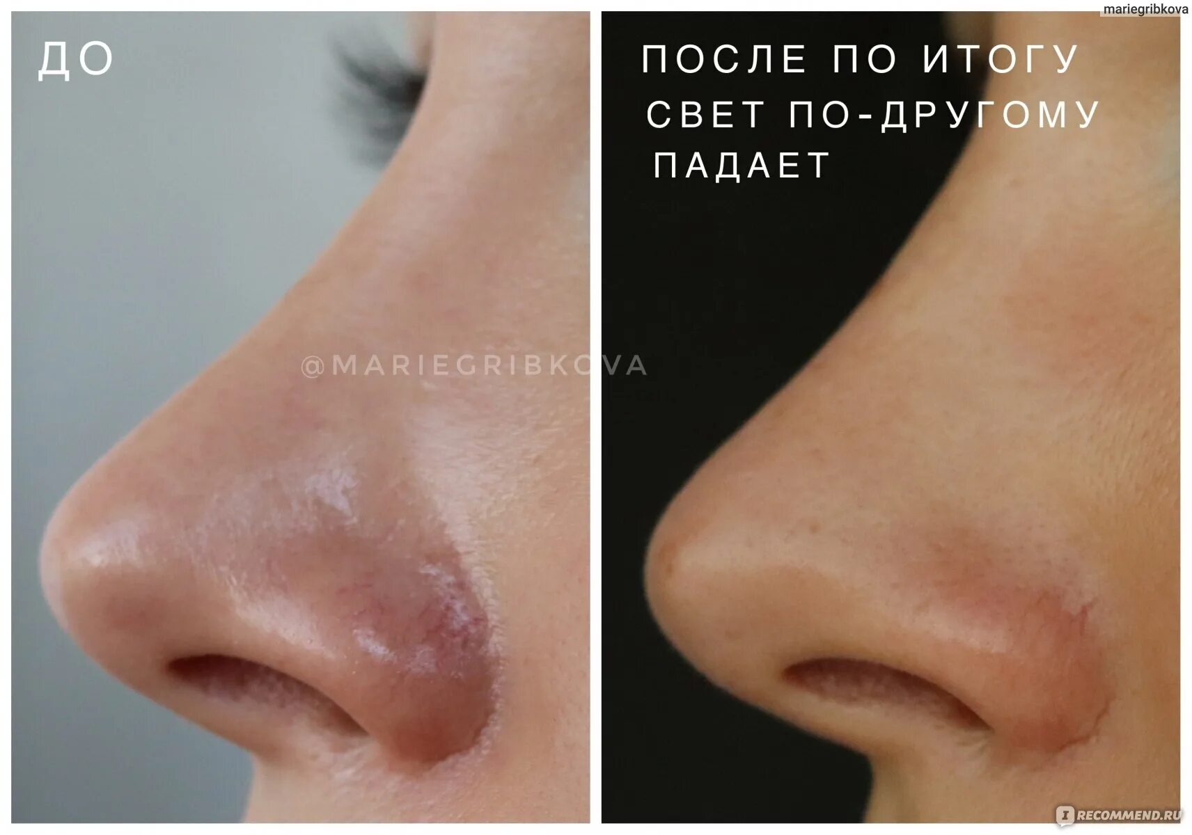 Как убрать капиллярные сетки