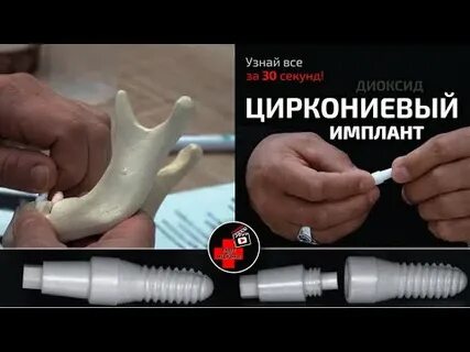 Импланты в москве отзывы пациентов