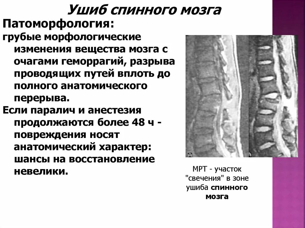 Сотрясение спинного. Травматические повреждения спинного мозга. Травма спинного мозга грудного отдела. Ушиб и сдавление спинного мозга. Повреждение спинного мозга в поясничном отделе.