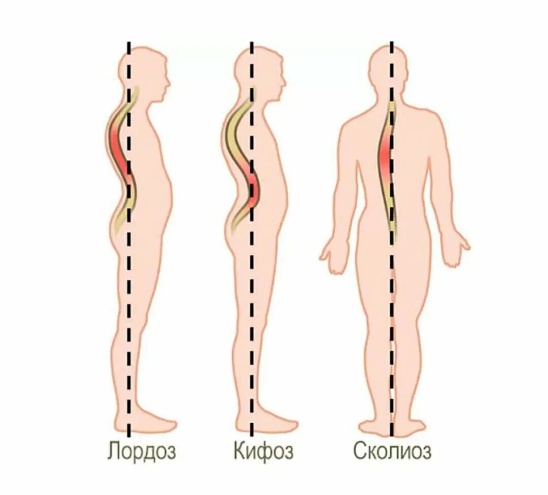 Осанка лордоз и кифоз. Искривление позвоночника лордоз кифоз сколиоз. Искривление позвоночника лагдох сктфох. Осанка лордоз кифоз сколиоз. Изгиб позвоночника назад