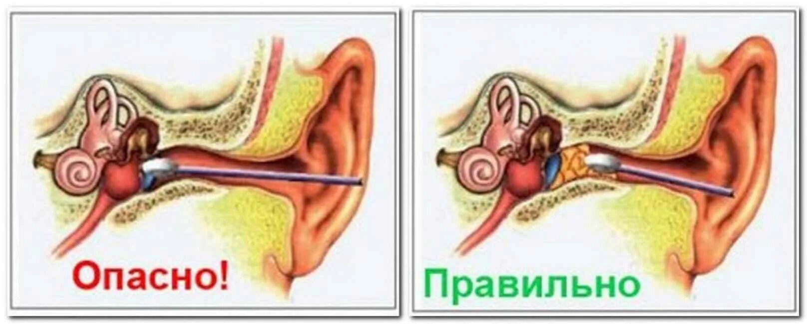 Как быстро почистить ухо. Как выглядит ушная пробка.