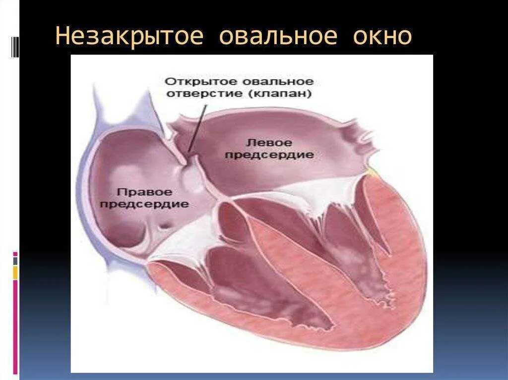 1 3 окно в сердце. Незаращение овального окна. Незакрытое овальное окно в сердце у новорожденного. Незаращение овального окна у детей. Открытое овальное окно предсердий.