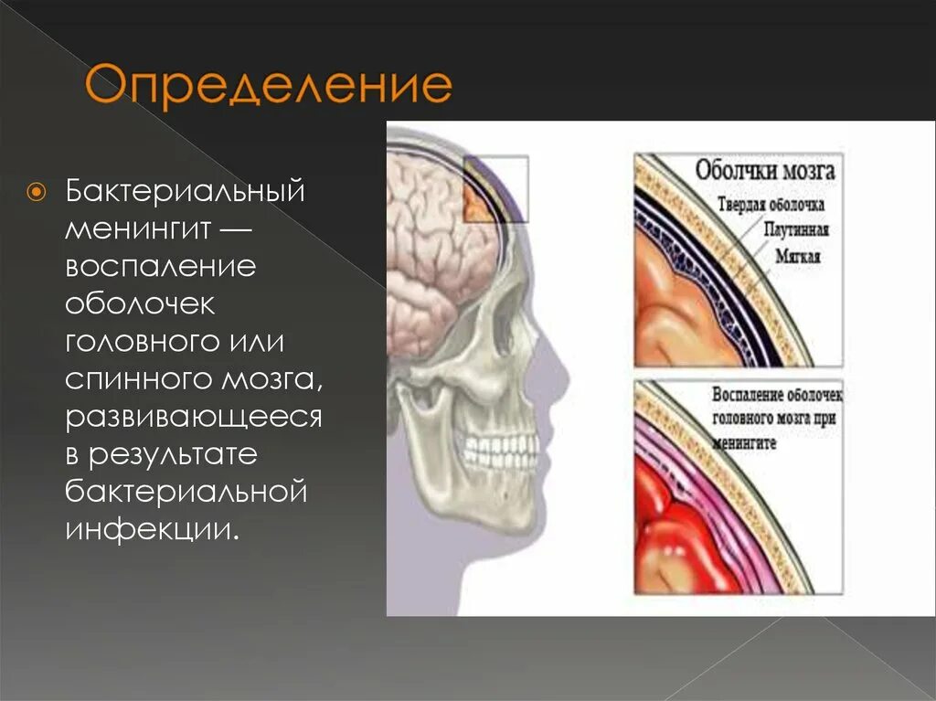 Менингит головной оболочки. Воспаление оболочек головного. Воспаление мозговых оболочек. Менингит воспаление оболочек головного мозга. Воспаление головного мозга латынь