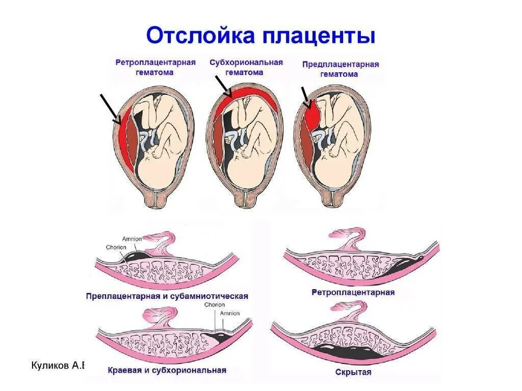 Забеременела на 7 цикл. Отслоение плаценты при беременности 2 триместр. Диагностические критерии предлежание плаценты. Ранний симптом отслойки плаценты. Беременность отслойка плаценты на ранних сроках беременности.