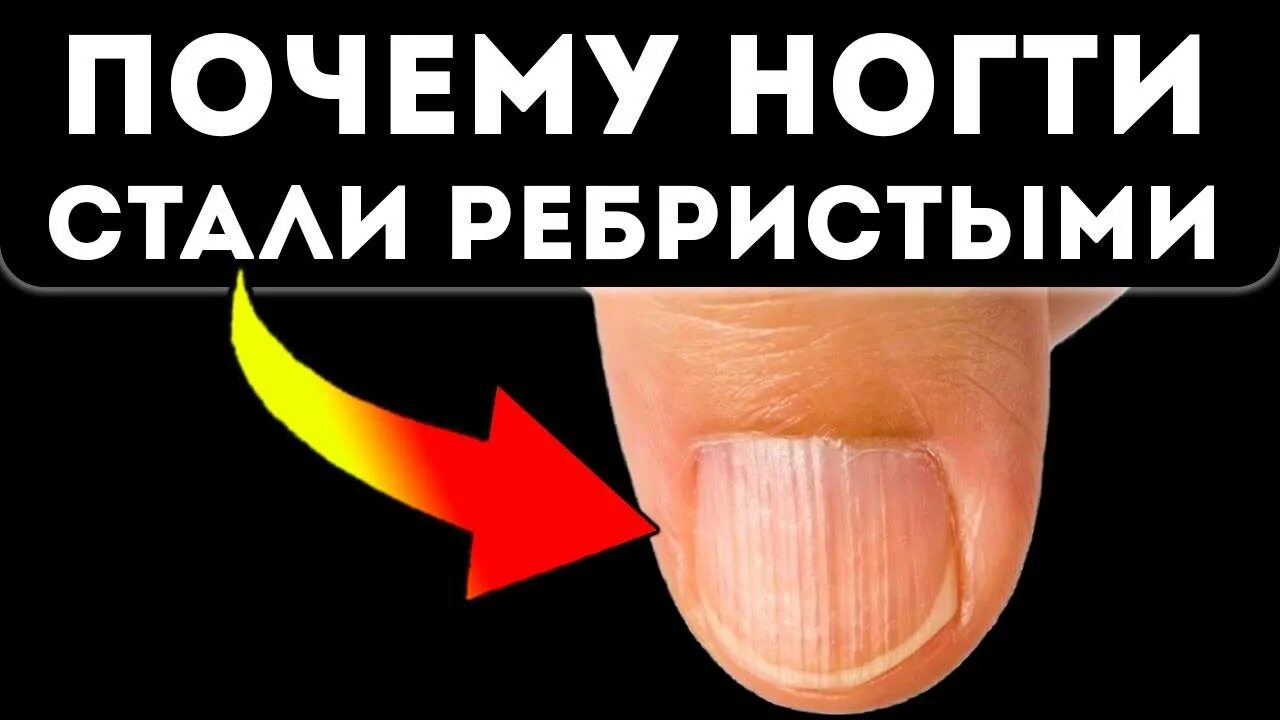 Ребристые ногти причина у мужчин. Вертикальная ребристость ногтя. Ногти продольные ребристые.