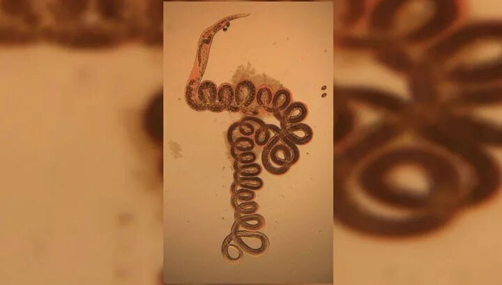 капсулы с паразитами для похудения. паразиты глисты гельминты. паразиты и ожирение человека. глисты и черви в организме человека. паразиты и вес.